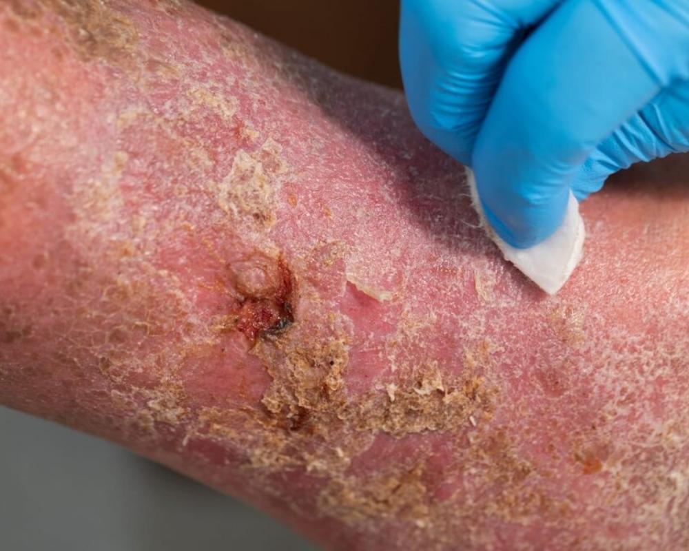 What You Need To Know About Arterial Leg Ulcers